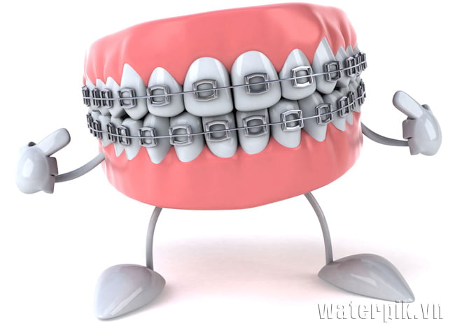 các phương pháp niềng răng