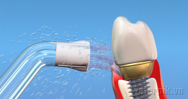 chăm sóc răng Implant 
